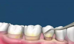 洗牙视频全过程,从准备到结束的全方位体验